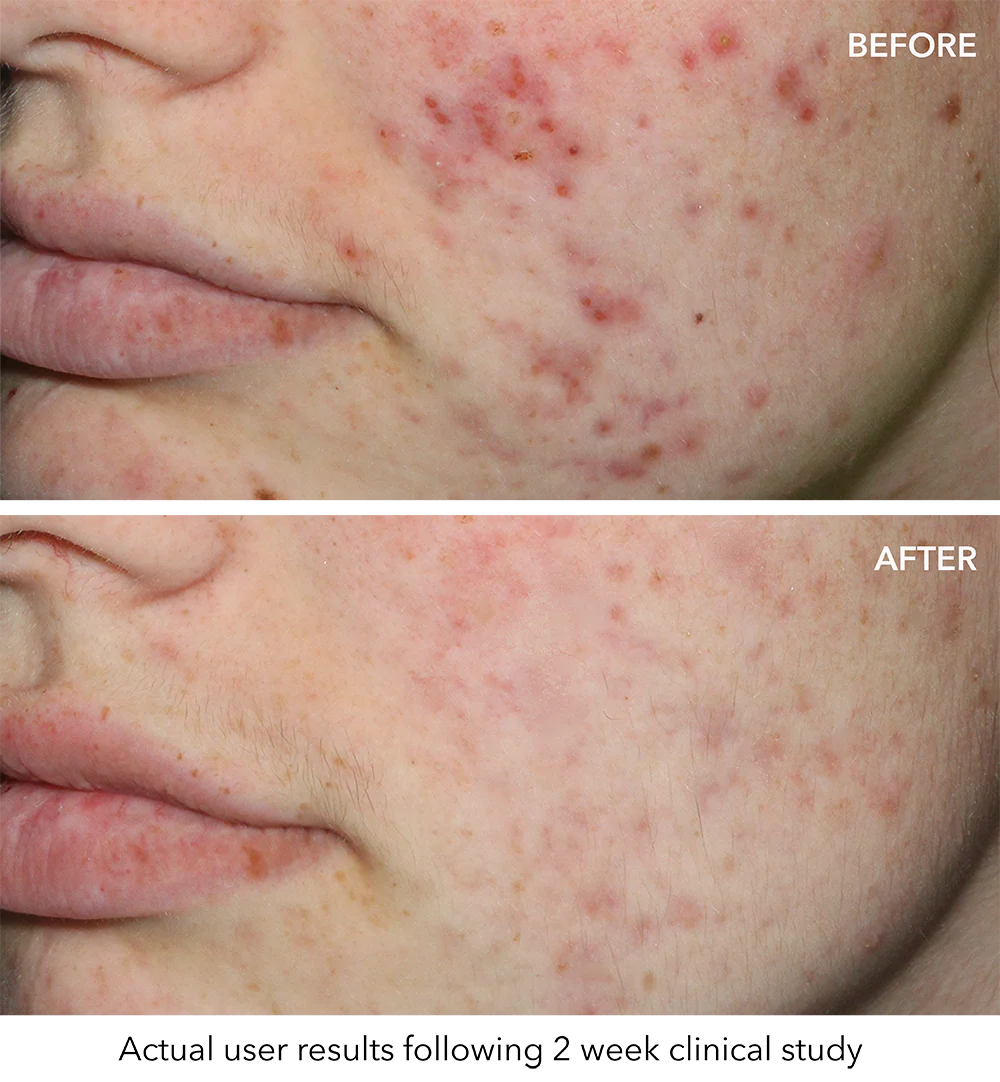 QuasarMD Blue - Image 3